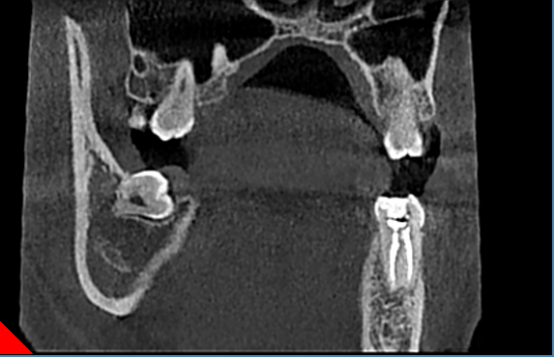 什么牌子口腔ct最好【口腔· 科普】CBCT（口腔CT）_https://www.jmylbn.com_新闻资讯_第11张
