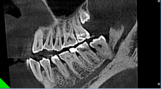 什么牌子口腔ct最好【口腔· 科普】CBCT（口腔CT）_https://www.jmylbn.com_新闻资讯_第25张