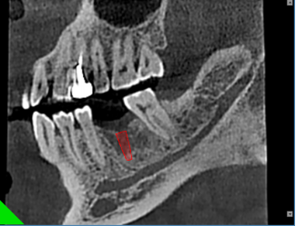 什么牌子口腔ct最好【口腔· 科普】CBCT（口腔CT）_https://www.jmylbn.com_新闻资讯_第4张