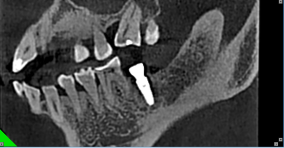 什么牌子口腔ct最好【口腔· 科普】CBCT（口腔CT）_https://www.jmylbn.com_新闻资讯_第7张