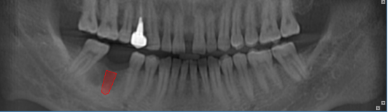 什么牌子口腔ct最好【口腔· 科普】CBCT（口腔CT）_https://www.jmylbn.com_新闻资讯_第2张