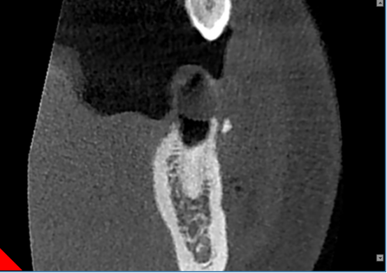 什么牌子口腔ct最好【口腔· 科普】CBCT（口腔CT）_https://www.jmylbn.com_新闻资讯_第26张