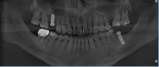 什么牌子口腔ct最好【口腔· 科普】CBCT（口腔CT）_https://www.jmylbn.com_新闻资讯_第5张
