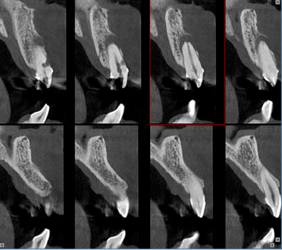 什么牌子口腔ct最好【口腔· 科普】CBCT（口腔CT）_https://www.jmylbn.com_新闻资讯_第21张