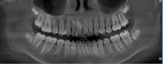 什么牌子口腔ct最好【口腔· 科普】CBCT（口腔CT）_https://www.jmylbn.com_新闻资讯_第16张