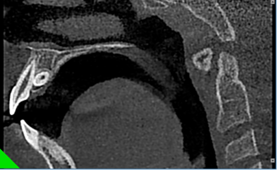 什么牌子口腔ct最好【口腔· 科普】CBCT（口腔CT）_https://www.jmylbn.com_新闻资讯_第17张
