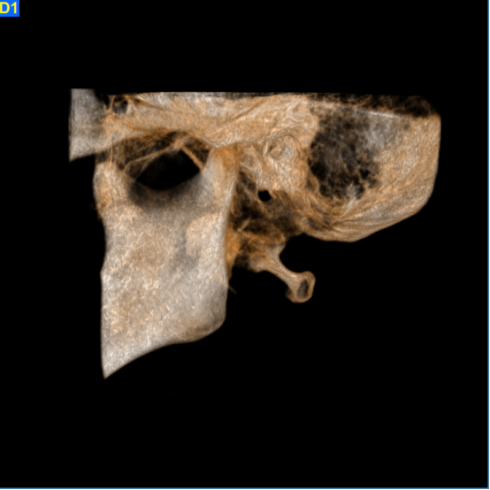 什么牌子口腔ct最好【口腔· 科普】CBCT（口腔CT）_https://www.jmylbn.com_新闻资讯_第13张