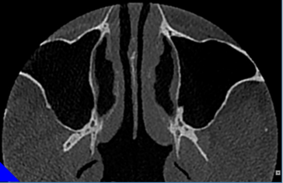 什么牌子口腔ct最好【口腔· 科普】CBCT（口腔CT）_https://www.jmylbn.com_新闻资讯_第29张