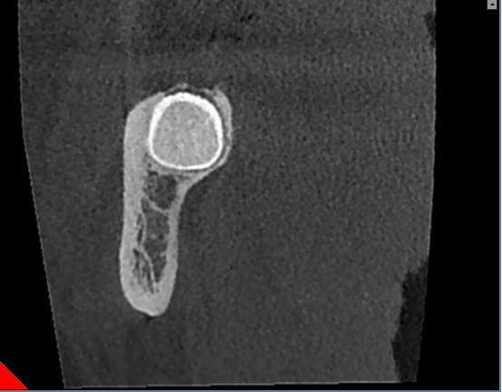 什么牌子口腔ct最好【口腔· 科普】CBCT（口腔CT）_https://www.jmylbn.com_新闻资讯_第23张