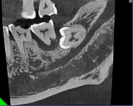 什么牌子口腔ct最好【口腔· 科普】CBCT（口腔CT）_https://www.jmylbn.com_新闻资讯_第22张