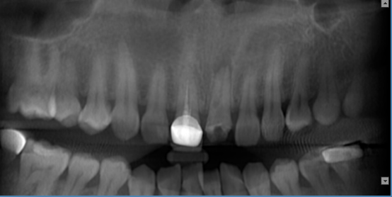 什么牌子口腔ct最好【口腔· 科普】CBCT（口腔CT）_https://www.jmylbn.com_新闻资讯_第20张