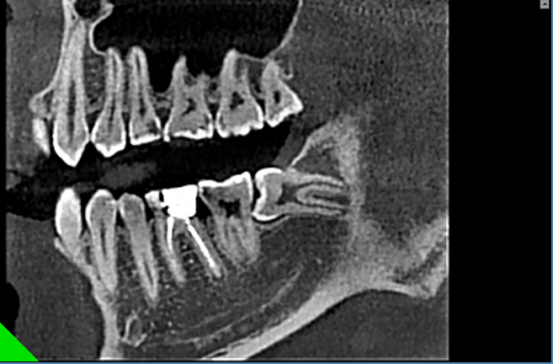 什么牌子口腔ct最好【口腔· 科普】CBCT（口腔CT）_https://www.jmylbn.com_新闻资讯_第9张