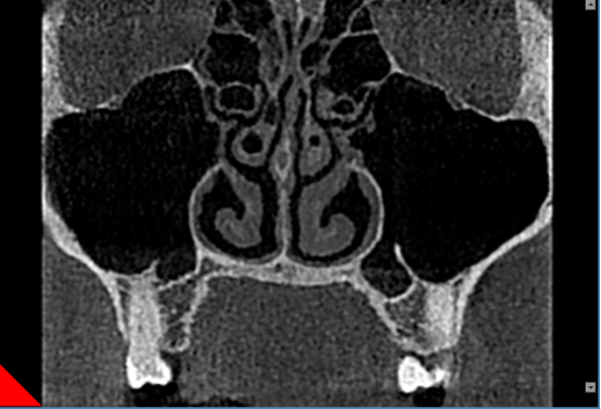 什么牌子口腔ct最好【口腔· 科普】CBCT（口腔CT）_https://www.jmylbn.com_新闻资讯_第30张