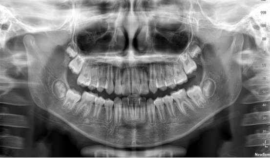 什么牌子口腔ct最好【口腔· 科普】CBCT（口腔CT）_https://www.jmylbn.com_新闻资讯_第14张
