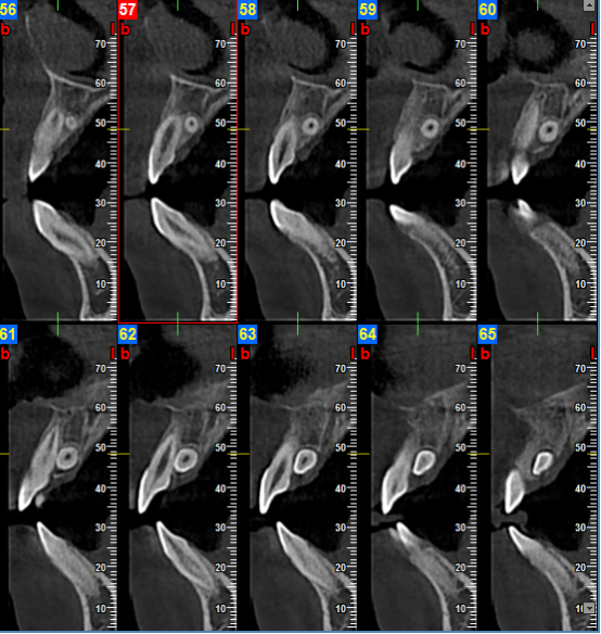 什么牌子口腔ct最好【口腔· 科普】CBCT（口腔CT）_https://www.jmylbn.com_新闻资讯_第18张