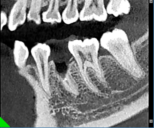 什么牌子口腔ct最好【口腔· 科普】CBCT（口腔CT）_https://www.jmylbn.com_新闻资讯_第27张