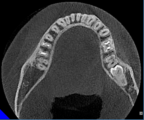 什么牌子口腔ct最好【口腔· 科普】CBCT（口腔CT）_https://www.jmylbn.com_新闻资讯_第10张