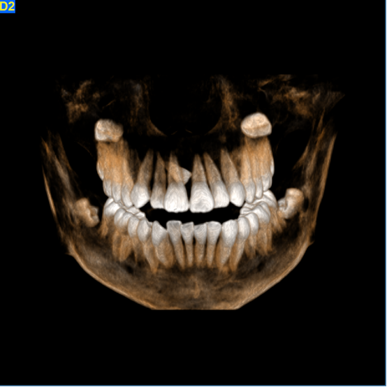 什么牌子口腔ct最好【口腔· 科普】CBCT（口腔CT）_https://www.jmylbn.com_新闻资讯_第19张