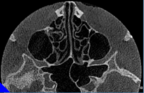 什么牌子口腔ct最好【口腔· 科普】CBCT（口腔CT）_https://www.jmylbn.com_新闻资讯_第28张