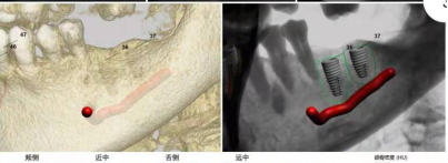 什么牌子口腔ct最好【口腔· 科普】CBCT（口腔CT）_https://www.jmylbn.com_新闻资讯_第8张