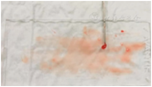 穿刺架怎么消毒超声引导下甲状腺结节细针穿刺细胞学检查实践指南(2019版)_https://www.jmylbn.com_新闻资讯_第25张