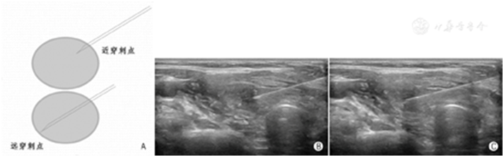 穿刺架怎么消毒超声引导下甲状腺结节细针穿刺细胞学检查实践指南(2019版)_https://www.jmylbn.com_新闻资讯_第17张