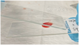 穿刺架怎么消毒超声引导下甲状腺结节细针穿刺细胞学检查实践指南(2019版)_https://www.jmylbn.com_新闻资讯_第23张