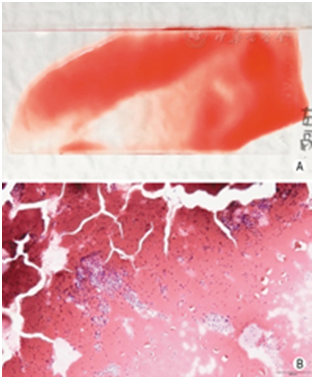 穿刺架怎么消毒超声引导下甲状腺结节细针穿刺细胞学检查实践指南(2019版)_https://www.jmylbn.com_新闻资讯_第27张