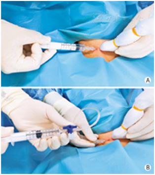 穿刺架怎么消毒超声引导下甲状腺结节细针穿刺细胞学检查实践指南(2019版)_https://www.jmylbn.com_新闻资讯_第16张