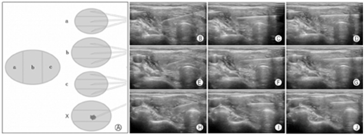 穿刺架怎么消毒超声引导下甲状腺结节细针穿刺细胞学检查实践指南(2019版)_https://www.jmylbn.com_新闻资讯_第19张