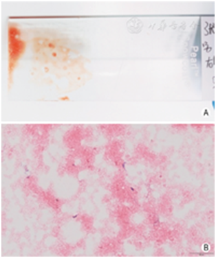 穿刺架怎么消毒超声引导下甲状腺结节细针穿刺细胞学检查实践指南(2019版)_https://www.jmylbn.com_新闻资讯_第29张