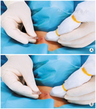 穿刺架怎么消毒超声引导下甲状腺结节细针穿刺细胞学检查实践指南(2019版)_https://www.jmylbn.com_新闻资讯_第15张