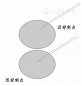 穿刺架怎么消毒超声引导下甲状腺结节细针穿刺细胞学检查实践指南(2019版)_https://www.jmylbn.com_新闻资讯_第18张
