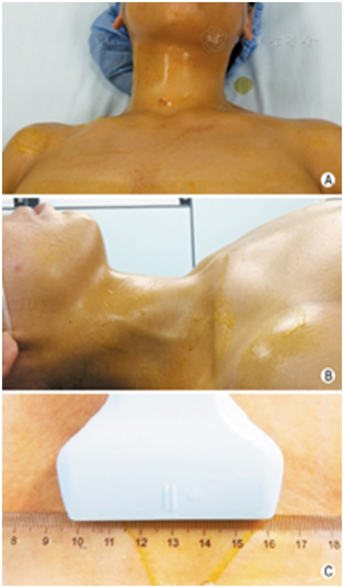 穿刺架怎么消毒超声引导下甲状腺结节细针穿刺细胞学检查实践指南(2019版)_https://www.jmylbn.com_新闻资讯_第9张