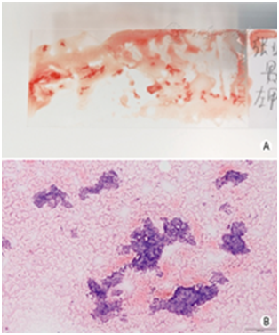 穿刺架怎么消毒超声引导下甲状腺结节细针穿刺细胞学检查实践指南(2019版)_https://www.jmylbn.com_新闻资讯_第28张