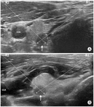 穿刺架怎么消毒超声引导下甲状腺结节细针穿刺细胞学检查实践指南(2019版)_https://www.jmylbn.com_新闻资讯_第20张