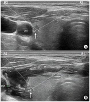 穿刺架怎么消毒超声引导下甲状腺结节细针穿刺细胞学检查实践指南(2019版)_https://www.jmylbn.com_新闻资讯_第21张