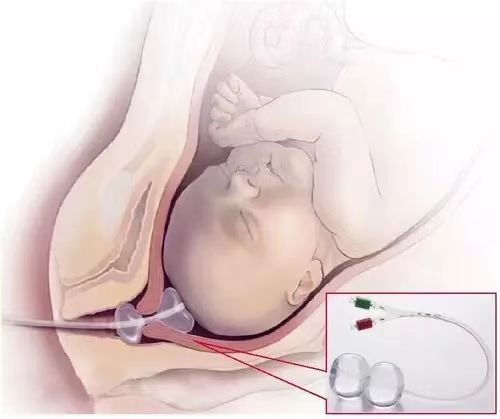 为什么要扩张宫颈【科普】带你了解宫颈球囊扩张术_https://www.jmylbn.com_新闻资讯_第5张