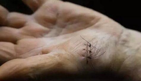 合成外缝线为什么贵科普视窗丨手术缝线知多少_https://www.jmylbn.com_新闻资讯_第3张