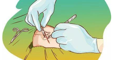 合成外缝线为什么贵科普视窗丨手术缝线知多少_https://www.jmylbn.com_新闻资讯_第4张