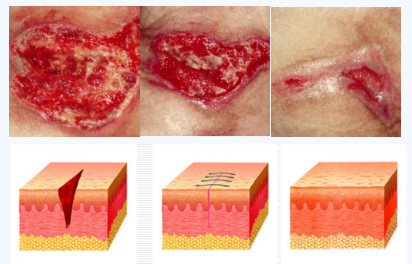 人工敷料怎么照顾伤口护理知识 ｜ 怎样能让伤口快速愈合？这几招学起来_https://www.jmylbn.com_新闻资讯_第5张