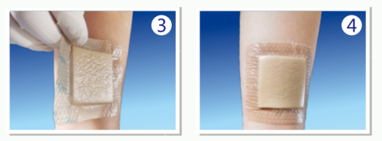 人工敷料怎么照顾伤口护理知识 ｜ 怎样能让伤口快速愈合？这几招学起来_https://www.jmylbn.com_新闻资讯_第16张