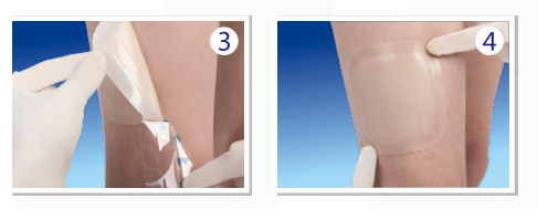 人工敷料怎么照顾伤口护理知识 ｜ 怎样能让伤口快速愈合？这几招学起来_https://www.jmylbn.com_新闻资讯_第11张