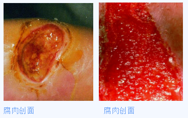 人工敷料怎么照顾伤口护理知识 ｜ 怎样能让伤口快速愈合？这几招学起来_https://www.jmylbn.com_新闻资讯_第3张