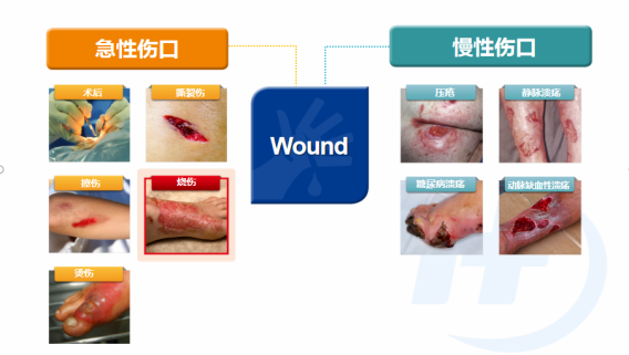 人工敷料怎么照顾伤口护理知识 ｜ 怎样能让伤口快速愈合？这几招学起来_https://www.jmylbn.com_新闻资讯_第2张