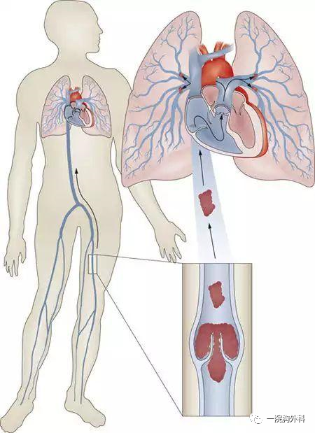 血栓泵是什么深静脉血栓预防处理及气压泵的使用_https://www.jmylbn.com_新闻资讯_第12张