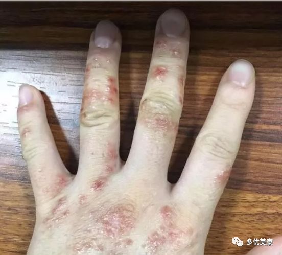 手上长了湿疹我们该怎么办呢 多优美康 微信公众号文章阅读 Wemp