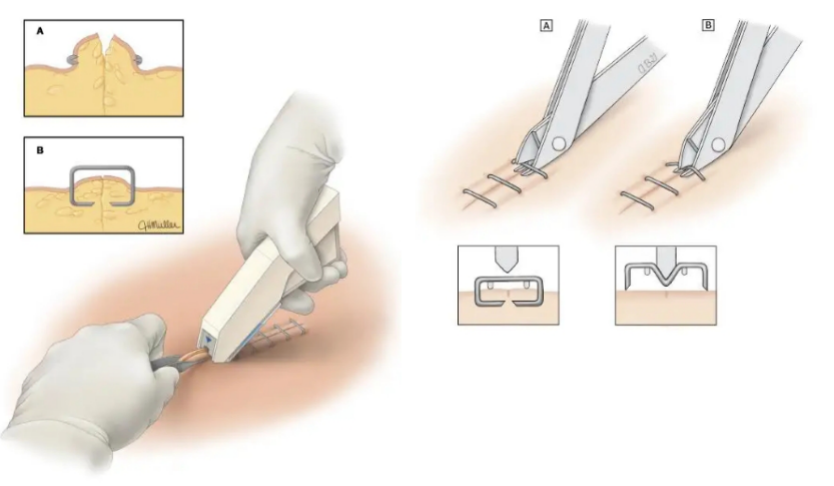 为什么要用皮肤缝合器【川骨知乎】缝合伤口用 “订书机”!？ 带您了解皮肤缝合器_https://www.jmylbn.com_新闻资讯_第14张