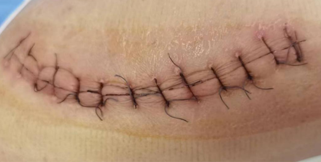 为什么要用皮肤缝合器【川骨知乎】缝合伤口用 “订书机”!？ 带您了解皮肤缝合器_https://www.jmylbn.com_新闻资讯_第10张