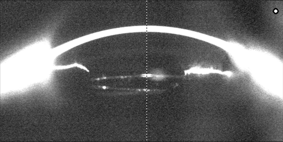 开睑器怎么用术说睛彩 ｜ 金海鹰教授：使用8-0缝线的无巩膜瓣人工晶体固定手术_https://www.jmylbn.com_新闻资讯_第25张